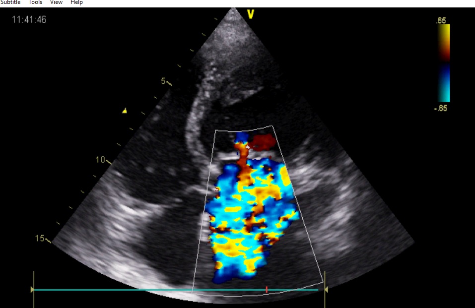 Identify The Disease From This Transthoracic Echo Image